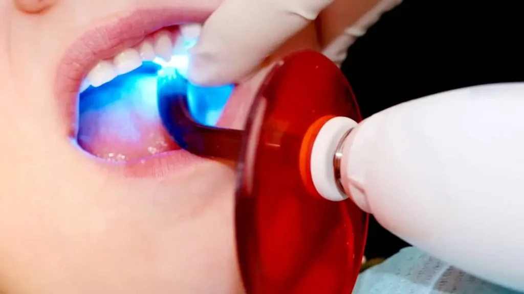 Dental Sealants