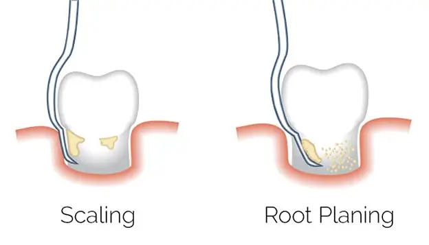 What is scaling and root planing